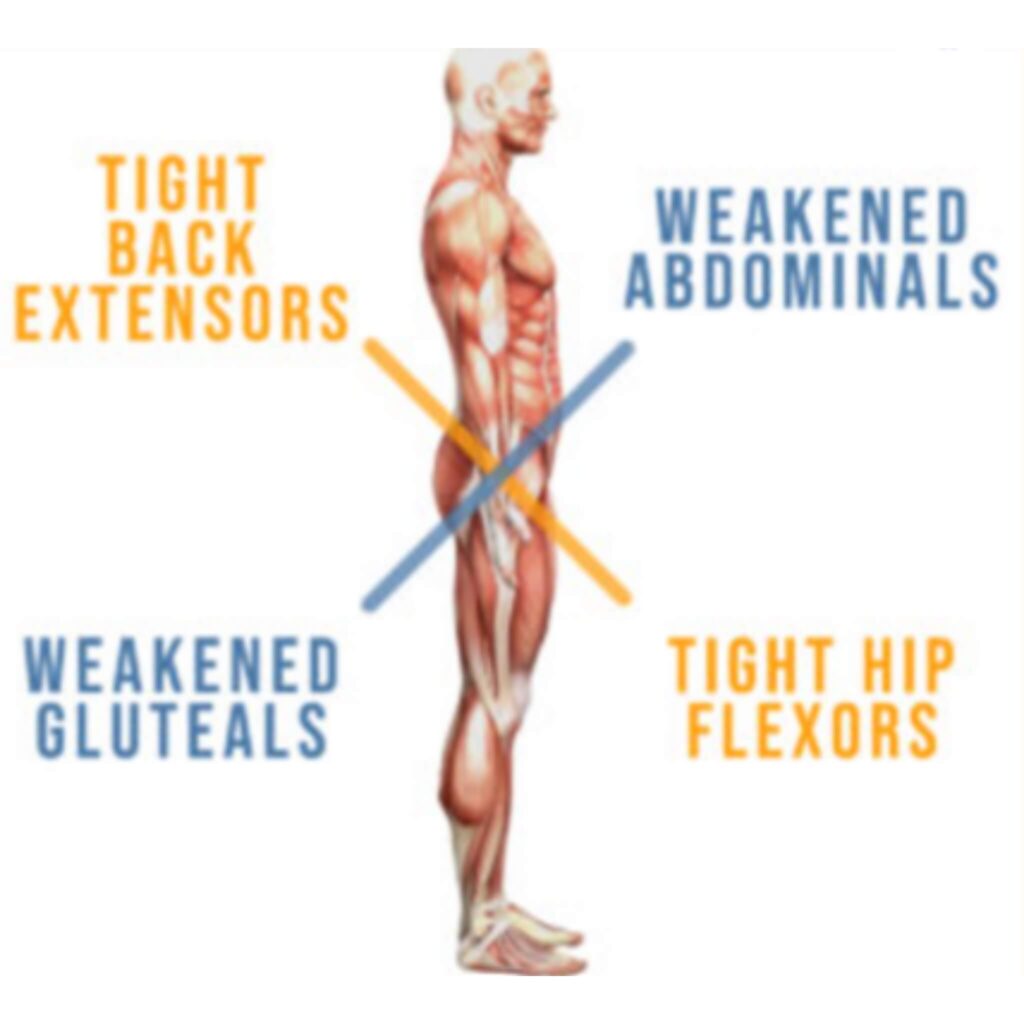 apakšējais krusteniskais sindroms masieru akadēmija - masieru kursi tiešsaistē - 1