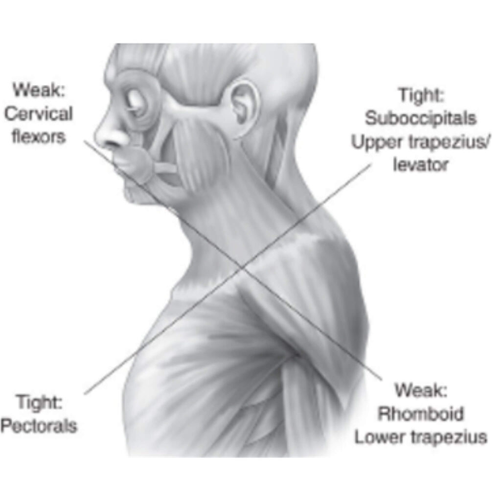 augšējais krusteniskais sindroms masieru akadēmija - masieru kursi tiešsaistē un klātienē - 1