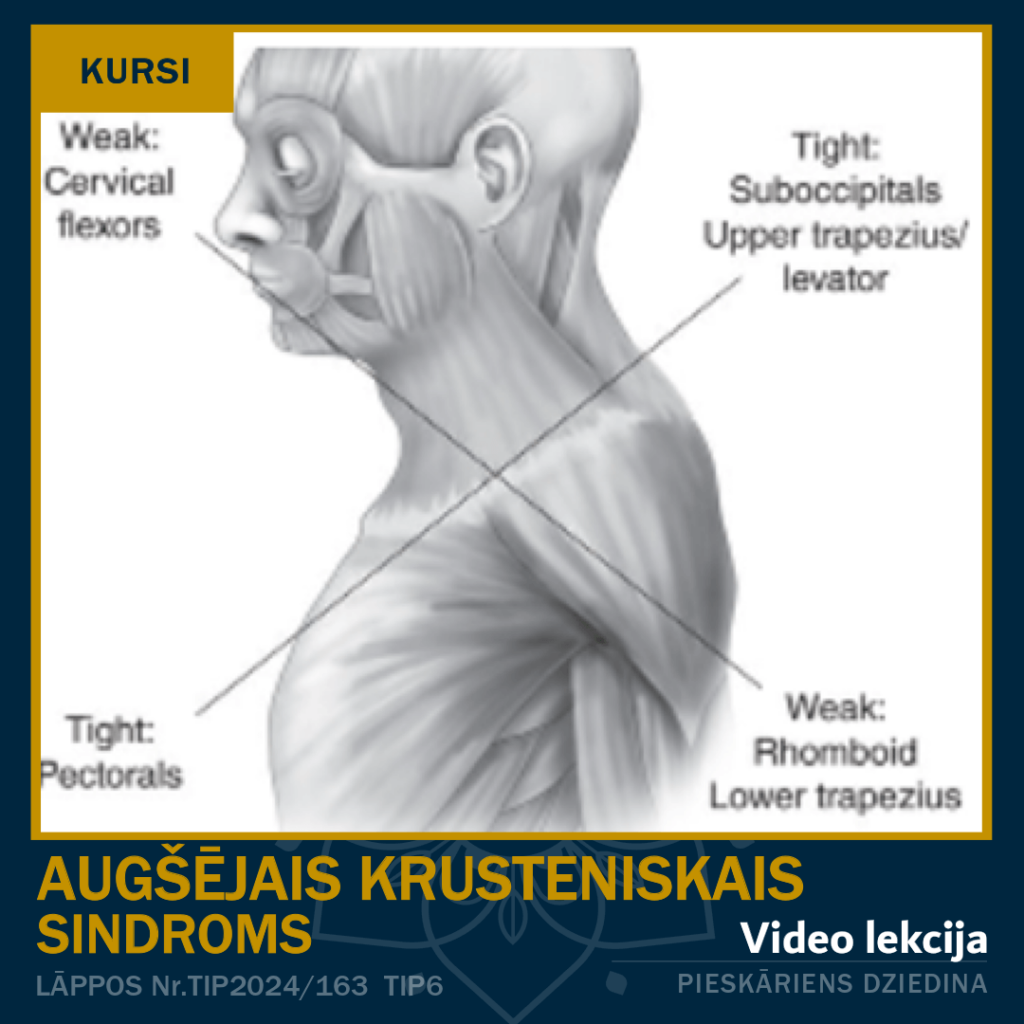 augšējais krusteniskais sindroms masieru akadēmija - masieru kursi tiešsaistē un klātienē